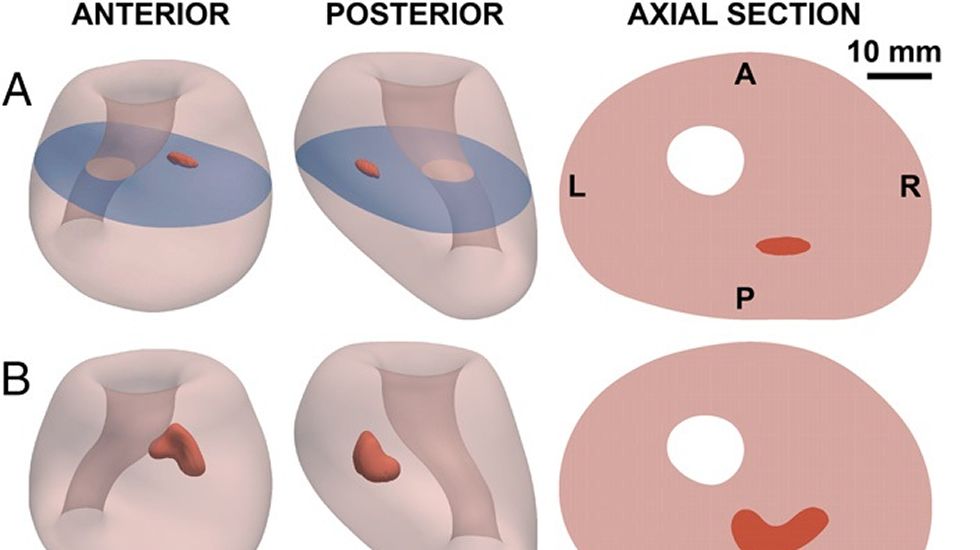 como un peligro para la prueba de cáncer de próstata