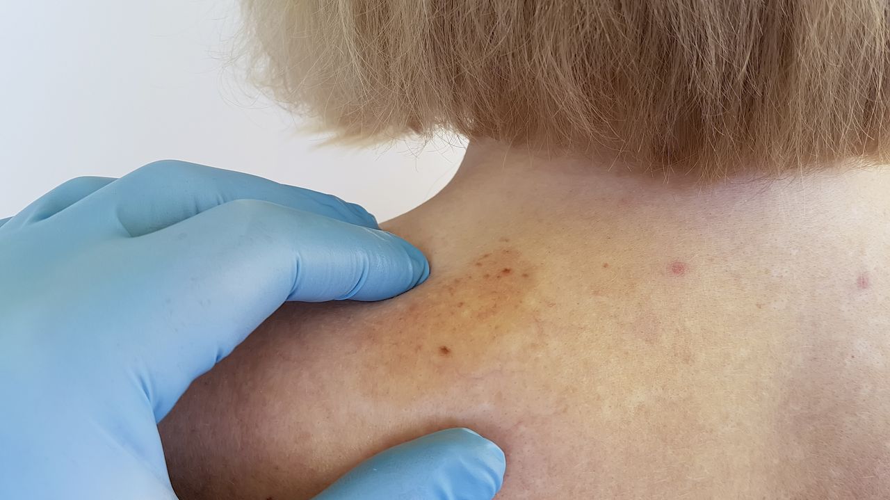 tipos de cancer de piel carcinoma basocelular