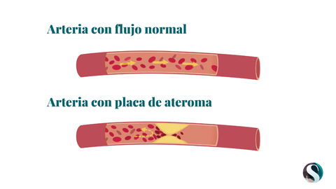 La placa de ateroma es una lesin en la pared interna de una arteria en la que se acumula colesterol, impidiendo el flujo de sangre.