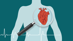 El stent es dispositivo met�lico con forma de malla.