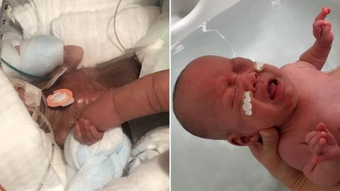 A la izquierda, el bebé cinco días después de nacer con 268 gramos. A la derecha , el niño a punto de ser dado de alta con 3 kilos