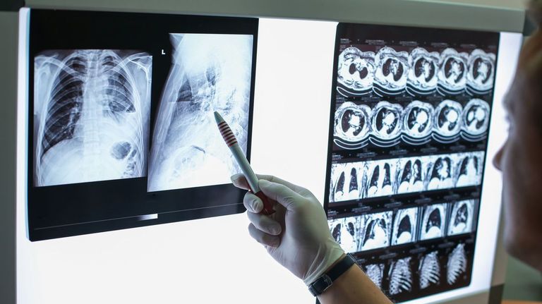 Pulmones dañados por la tuberculosis