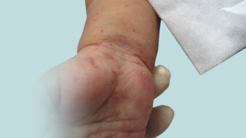 Marcas de la escabiosis o sarna provocadas por el caro en la piel de una persona.