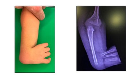 Imagen de la mano del niño coruñés operado en Barcelona para corregirle una malformación