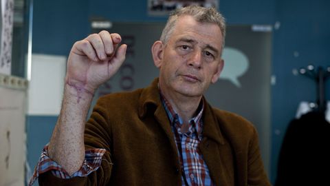Abel Vázquez Pardo, de 60 años, sigue rehabilitación para recuperar las funciones de la mano que le reimplantaron