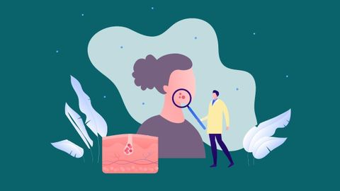 El acné afecta hasta a un 90 % de los adolescentes.