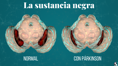La zona del cerebro donde se produce la pérdida de neuronas es una estructura llamada sustancia negra situada en la parte media del cerebro.