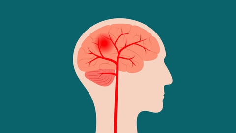 El coágulo de sangre en el cerebro puede estar en las arterias o en las venas. 