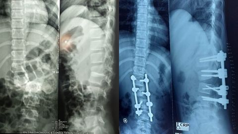Radiografía de la columna vertebral de Nupur antes de operarse ( a la izquierda) y tras la intervención (a la derecha)