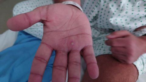 Un paciente británico muestra una de las pápulas que le produjo la enfermedad