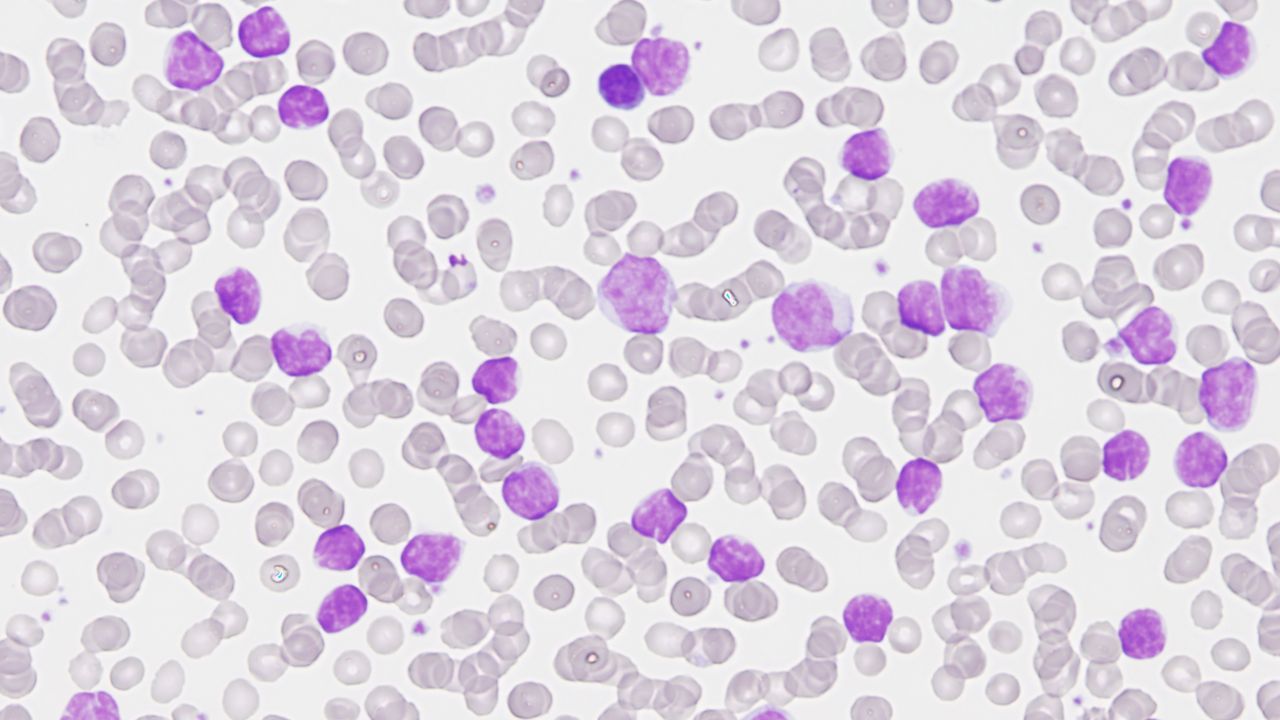 Citología de una leucemia linfática crónica