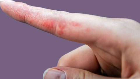 La dishidrosis causa ampollas en la piel, especialmente en la zona lateral de los dedos.