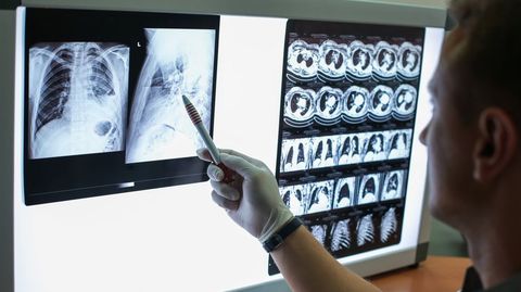 Radiografa de un paciente con tuberculosis en una imagen de archivo