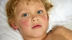 El virus de la bofetada se llama as� por el sarpullido que produce en la zona de la mejilla.