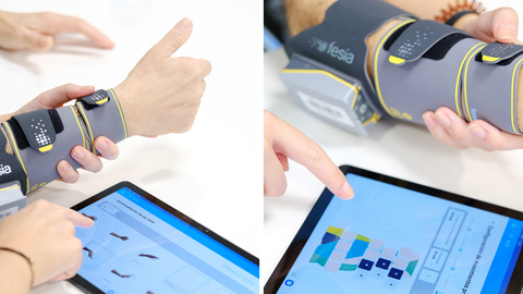 Uso del dispositivo Fesia en la rehabilitacin de una mano.