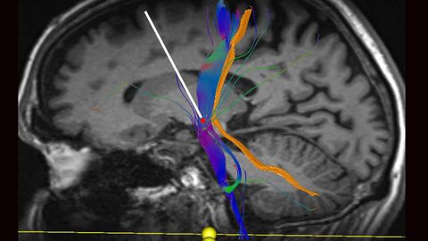 Imagen tomada por resonancia magn�tica de la zona del cerebro donde se instalan los electrodos (en amarillo) y se�alizaci�n del  �ngulo para la inserci�n (en blanco)