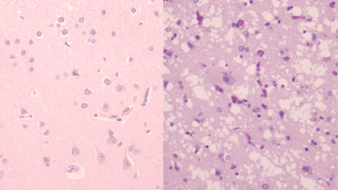 A la izquierda, una imagen al microscopio de tejido cerebral normal y a la derecha, uno afectado por enfermedad de Creutzfeldt-Jakob. «La patología produce un aspecto ''esponjoso'' debido a la aparición de pequeñas cavidades, junto con la pérdida de neuronas y la proliferación de células de soporte (gliosis), signos característicos de degeneración cerebral avanzada», explica San Millán.