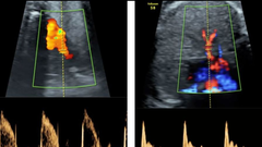 Reactividad vascular de los pulmones de fetos demasiado pequeños a partir del uso de técnicas informáticas y de IA (a la izquierda, principales arterias pulmonares; a la derecha, las arterias intrapulmonares)