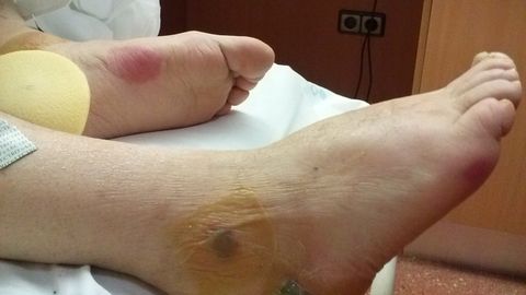 Las heridas que presentaban los pies de Emilio Álvarez García, más conocido como «Milio, el de Guita», el día de su ingreso hospitalario 