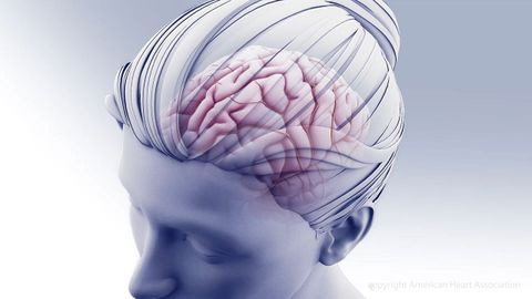 Ilustracin de la afectacin cerebral producida por el alzhimer
