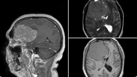 Imágenes del cerebro de la paciente en las que se observa el enorme tumor del lóbulo frontal
