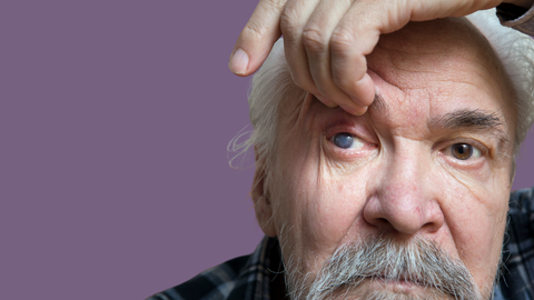 El glaucoma afecta en mayor medida a pacientes con miopía.