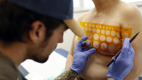 Álvaro Quesada realiza reconstrucciones de pezón en pacientes que se han sometido a mastectomías.