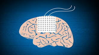 Unas 400.000 personas padecen epilepsia en Espa�a, y cada a�o, se detectan entre 12.400 y 22.000 nuevos casos.