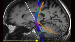 Asturias, pionera en la lucha contra el Parkinson