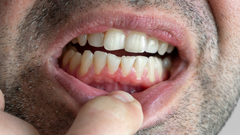 Las encas inflamadas y el sangrado de estas son signos de gingivitis.