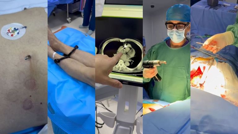 El paciente llegó con el punzón clavado en el pecho y estuvo engrilletado en todo momento mientras le operaban y le retiraban el objeto que le atravesó la aorta
