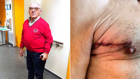 A la izquierda, Manuel posando en el hospital. A la derecha, su cicatriz en la axila hace unos días.