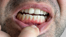 Las encas inflamadas y el sangrado de estas son signos de gingivitis.