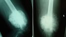 Estas imágenes son virtualmente diagnósticas de osteosarcoma