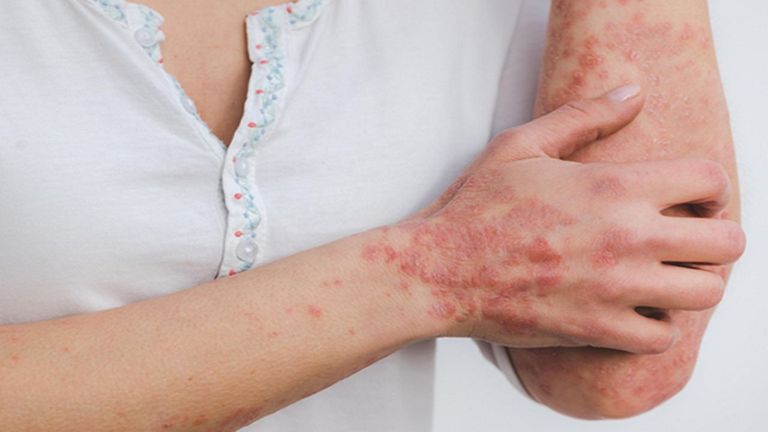 Un fármaco para la leucemia frena el interruptor que desencadena la psoriasis