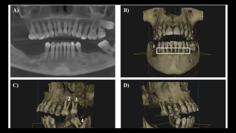 Imagen de la mandbula de la paciente con periodontitis relacionada con un cncer de colon