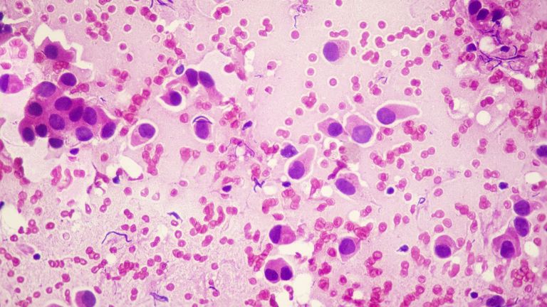 Las células infieles: la pista clave para anticipar el cáncer de mama