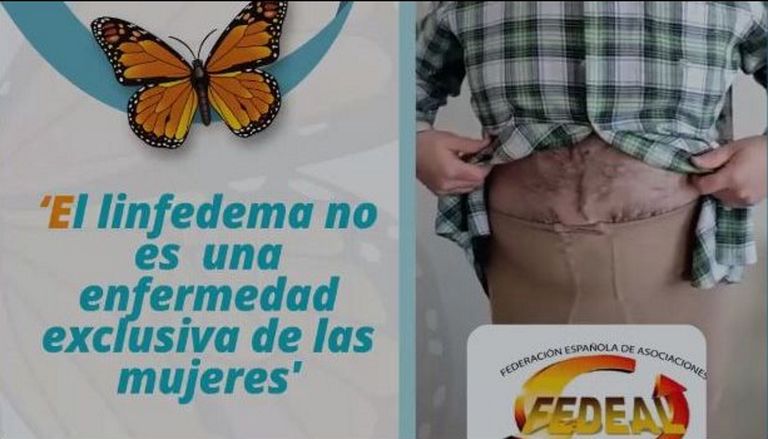 En el Día Mundial del Linfedema, la asociación AGL, que forma parte de Cogami, lanzó una campaña de sensibilización con el vídeo Chega a ti
