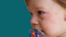La dermatitis atpica se caracteriza por picor en la piel y brotes de eczema crnicos.