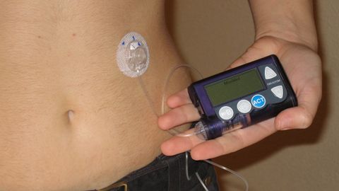 Paciente de diabetes con una bomba de insulina