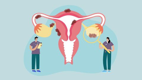 Se estima que la endometriosis afecta a más de dos millones de mujeres en España. 