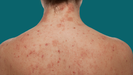 La dermatitis puede empeorar durante los meses de calor. 