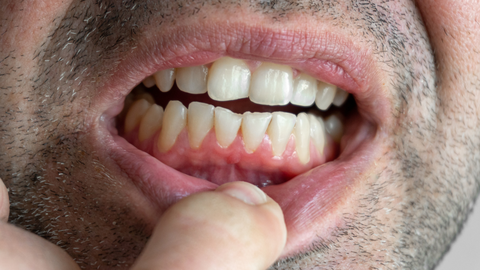 Las encías inflamadas y el sangrado de estas son signos de gingivitis.