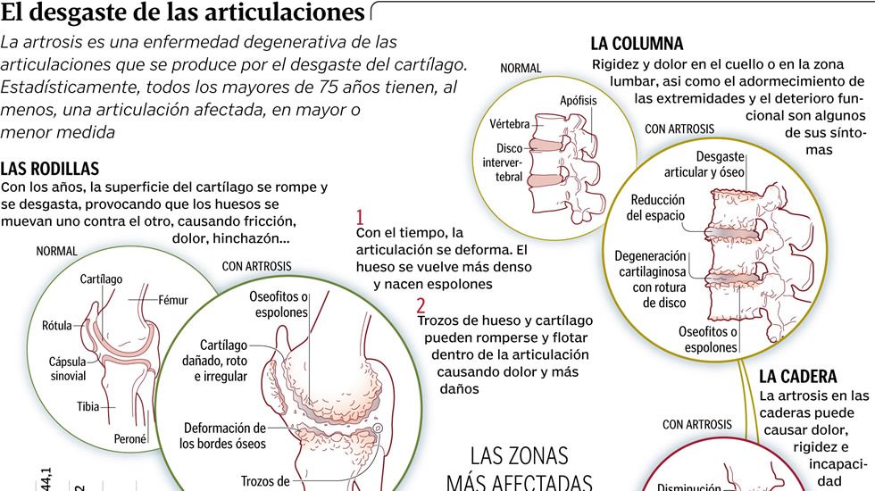 El desgaste de las articulaciones