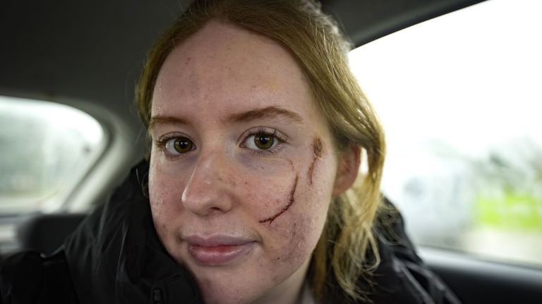 Noa, la conductora de Caldas a la que le cayó un pino gigante encima: «No recuerdo nada y no quiero recordar, debí pasar mucho miedo»