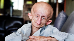 Beandri Booysen, influencer de TikTok, padeca progeria.