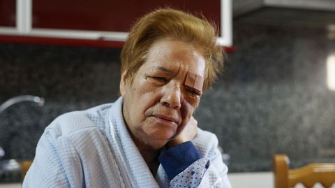 Feliciana Romero, atacada por tres pit bull en un pueblo de Muíños.