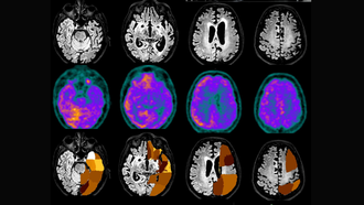 Cortes transversales de un cerebro con enfermedad pri�nica. Arriba, mediante resonancia. En el medio, a trav�s de un PET, donde se aprecia la reducci�n de glucosa consecuencia del deterioro (color rosado). Abajo, un an�lisis de inteligencia artificial que muestra autom�ticamente donde hay la reducci�n de glucosa. Fotograf�a de�Julia Cort�s y Pablo Aguiar, servicio de Medicina Nuclear del CHUS y an�lisis de software con NeuroCloud Qubiotech
