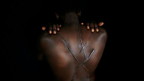 Hassan Mekki, un inmigrante sudans de 32 aos, muestra las cicatrices de su espalda  