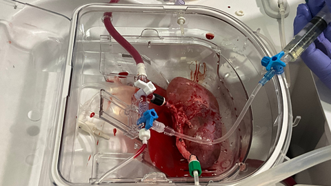Ri��n porcino conectado a la m�quina de perfusi�n normot�rmica. Este dispositivo permite preservar el ri��n vivo y oxigenado de manera ex vivo (fuera del cuerpo). La imagen muestra el momento de la infusi�n de los organoides renales humanos en el ri��n porcino.